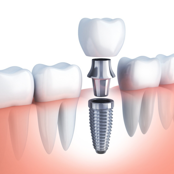 Everything you need to know about dental implants